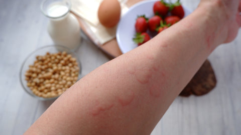 Roter Ausschlag an einem Arm
