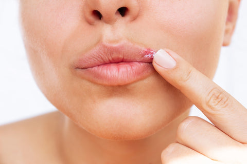 Frau fasst Herpes an der Lippe an