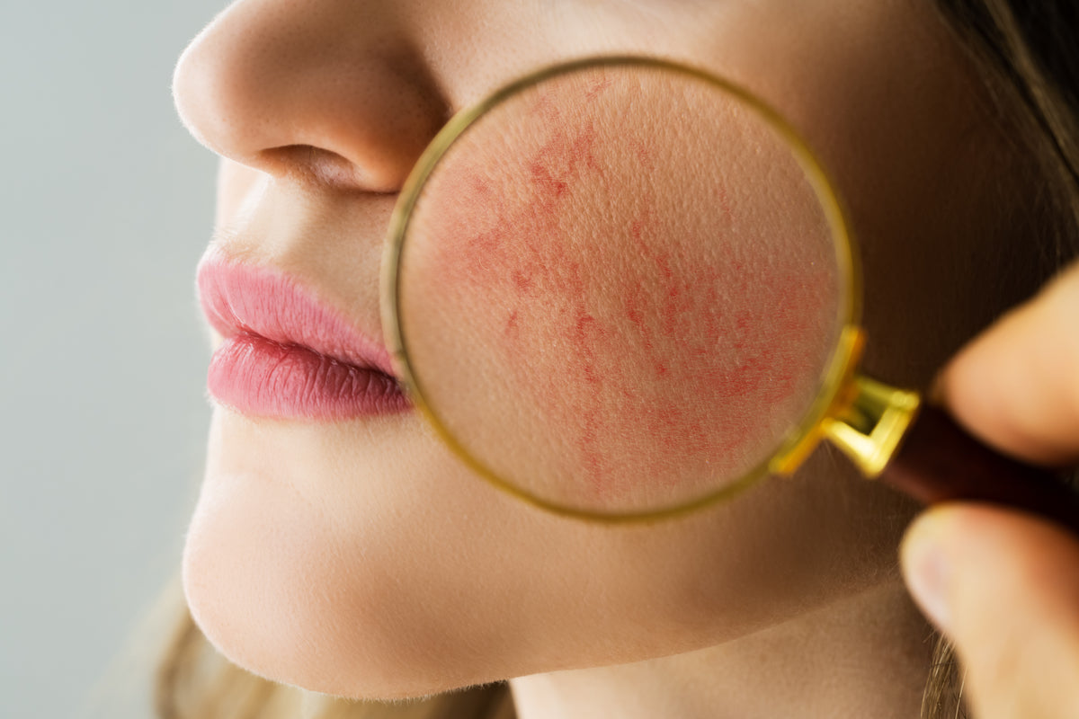 Adern bei einer Rosacea unter der Lupe