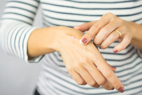 Frau cremt Wunde auf der Hand ein